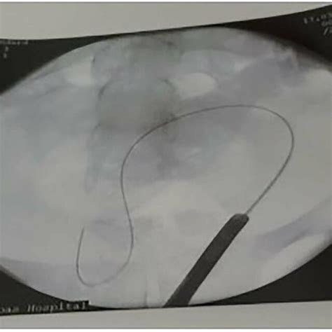 After Insertion Of Dj Stent Download Scientific Diagram