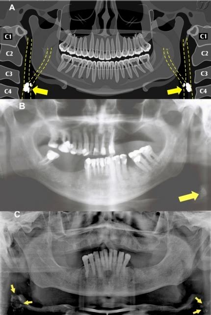 A Diagrammatic Illustration Of A Panoramic Radiograph Open I