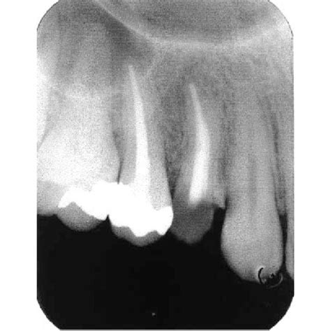 Follow Up Radiograph Showing Periapical Status Of Maxillary Left First