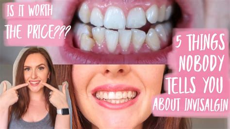 Invisalign 5 Things Nobody Tells You Invisalign Tips Worth The Cost