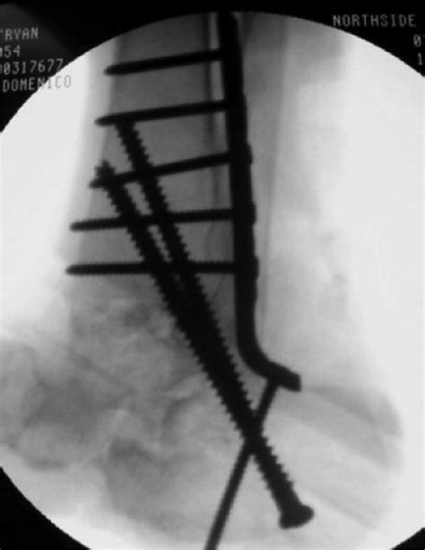 Posterior Approach Using Anterior Ankle Arthrodesis Locking Plate For