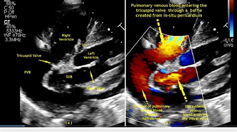 Post Operative D Echocardiography Apical Four Chamber Images With The