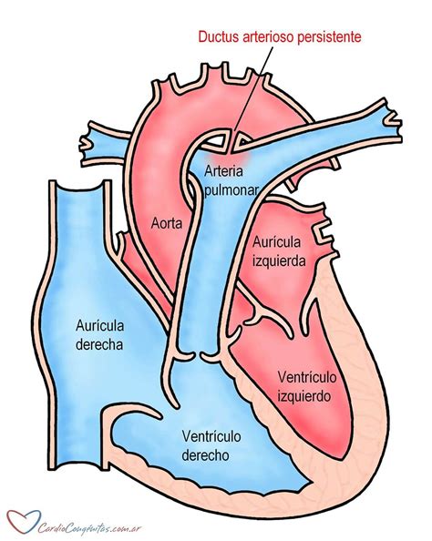 Ductus Arterioso Persistente