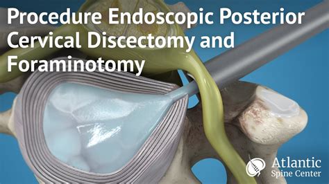 Procedure Endoscopic Posterior Cervical Discectomy And Foraminotomy