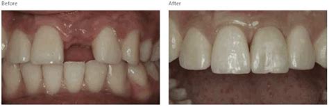 Titanium vs Zirconia Implants | NYC Dental Implants Center