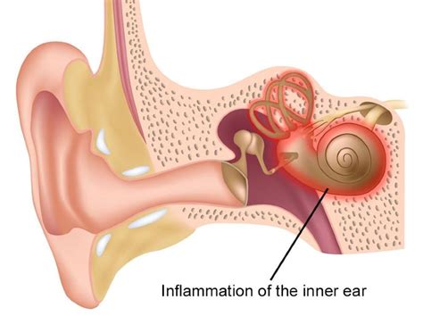 Autoimmune Inner Ear Disease Symptoms Causes And Treatments Harbor