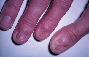 What is Lichen Planus? - Causes, Symptoms & Treatment | Study.com