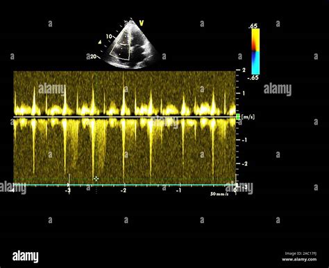 Screen of an ultrasound machine with a heart image Stock Photo - Alamy