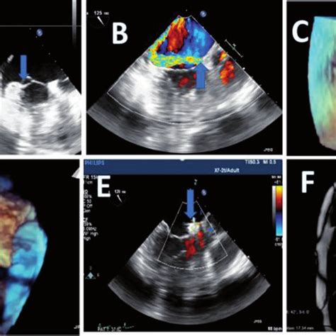 Two Dimensional Transesophageal Echocardiography Clearly Showing Some