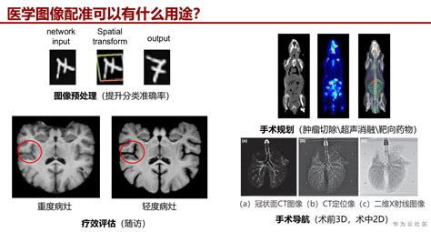 医学图像配准概览和深度学习图像配准前沿热点论文voxelmorph柔性配准 Csdn博客