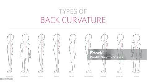 Jenis Kelengkungan Punggung Anakanak Infografis Penyakit Medis Versi