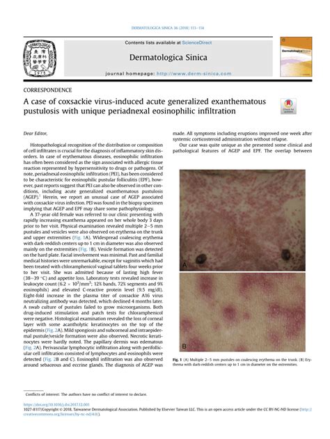 Pdf A Case Of Coxsackie Virus Induced Acute Generalized Exanthematous