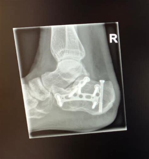 Katie Price Strips Naked For Shower Video After Walking For The First Time In Five Months After