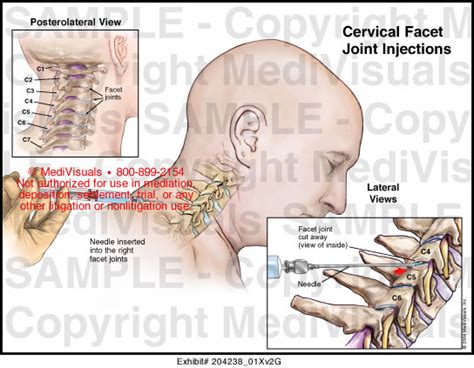 Cervical Facet Joint Injections Medical Illustration Medivisuals