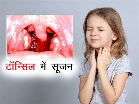 Tonsillitis Health Tips In Hindi Tonsillitis Health Articles In Hindi Health News In Hindi