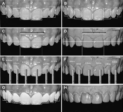 Figure 1 From Digital Smile Design For Computer Assisted Esthetic