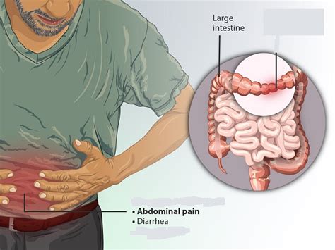 9 Signs You May Have Inflammatory Bowel Disease Symptoms Causes Effects Treatment And