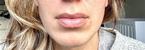 Considering filler or lip flip - long philtrum : r/PlasticSurgery