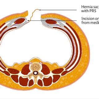 The Rives Stoppa Plane Is Developed Neurovascular Bundles Are