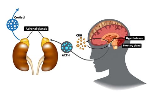 New Fda Approval Oral Medication For Cushings Disease Gt Health