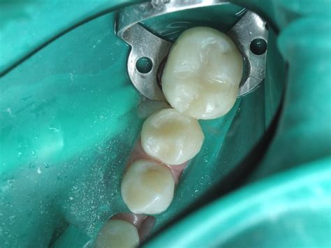 Garrison ReelMatrix | Retainerless Circumferential Matrix System