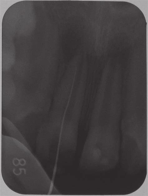 Periapical Radiograph Revealing Open Root Apex In Teeth And With