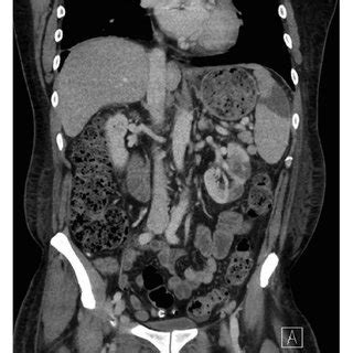 Computed Tomography Scan Of Chest Abdomen Pelvis Demonstrating Splenic