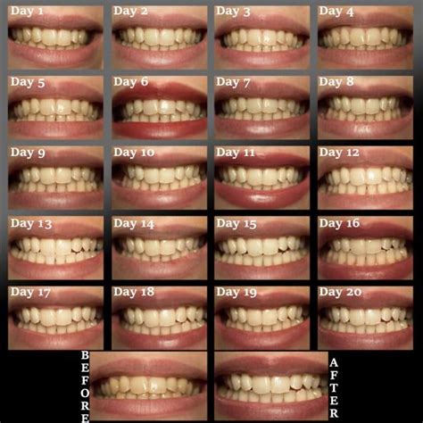 Do Crest D White Strips Work On Crooked Teeth Far Fetched Log Book