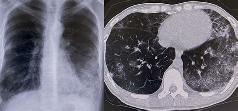 Chest Roentgenogram A And Computed Tomogram B Showing Bilateral