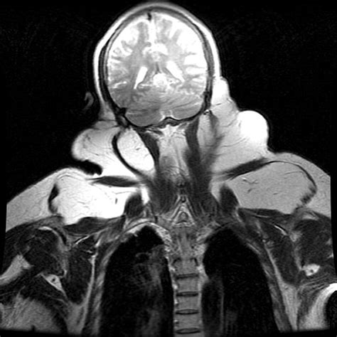 Surgical Treatment Of Multiple Symmetric Lipomatosis Madelungs