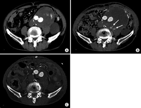 A Contrast Enhanced Abdominal Computed Tomography Ct At 1 Month