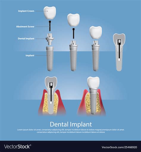 Human Teeth And Dental Implant Royalty Free Vector Image