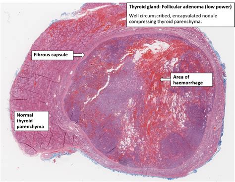 Thyroid Adenoma Histology