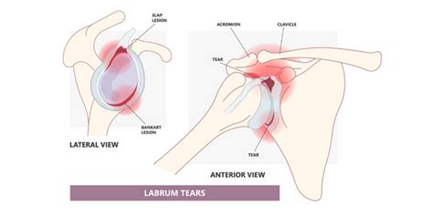 Labral Tears Shoulder Treatment Propel Physiotherapy Propel Physiotherapy