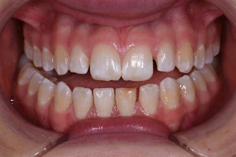 Peg Lateral Incisor Esthetic Correction Using Empress Direct