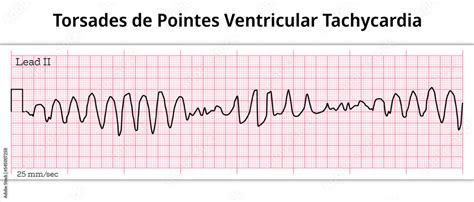 ECG Torsades de Pointes Ventricular Tachycardia - 8 Second ECG Paper Stock Vector | Adobe Stock