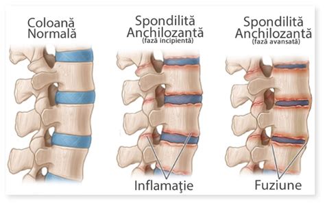 LITherapy Tratament Spondilita Anchilozanta Fără Operație