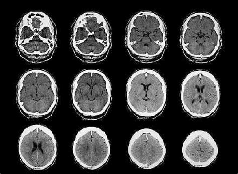 Sequência de exame de tomografia computadorizada do crânio paciente