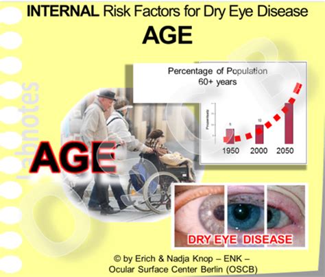 Overview How We Get Dry Eye Risk Factors Ocular Surface Center Berlin