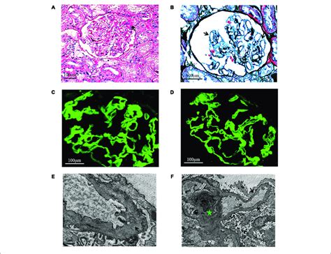 | Light microscopy. (A) Focal segmental glomeruosclerosis (x400, PAS ...