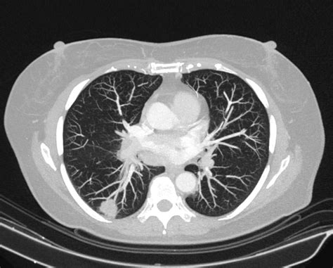 Pulmonary Adenocarcinoma Image