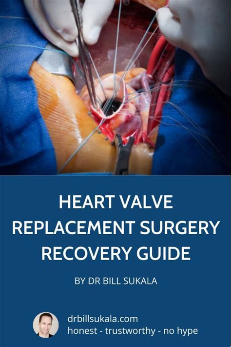 Heart valve surgery exercise guidelines – Artofit