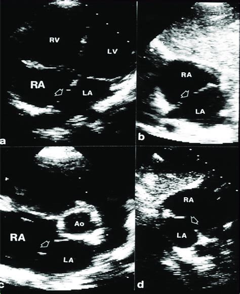 Two Dimensional Transthoracic Echocardiograms To Illustrate The Atrial