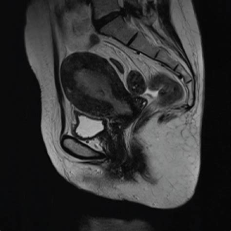 Magnetic Resonance Imaging Of The Pelvis T2 Weighted Imaging Revealing