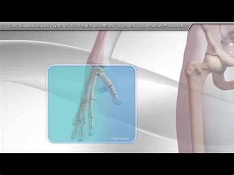 Cmc Suspensionplasty With Apl Graft And Internalbrace Ligament