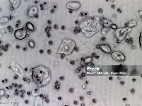 Microscopic Image Of Urinalysis Showing Plenty Pus Cells And Few