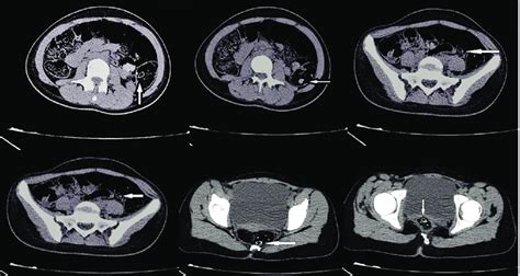 Abdominopelvic Computed Tomography Ct Scan Of A Girl With