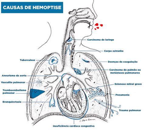 Tosse Com Sangue O Que Pode Ser - 35 causas de tosse com sangue (hemoptise)