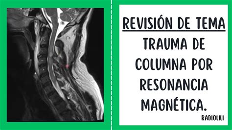 Trauma De Columna Por Resonancia Magn Tica Youtube