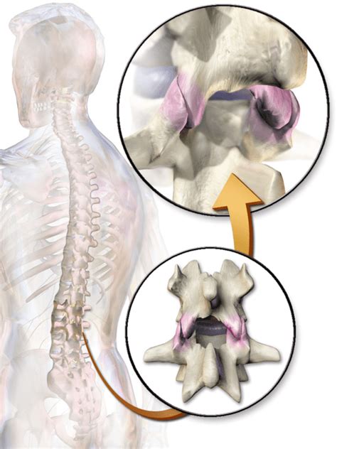 Treatment For Chronic Back Pain Facet Injections And Radiofrequency